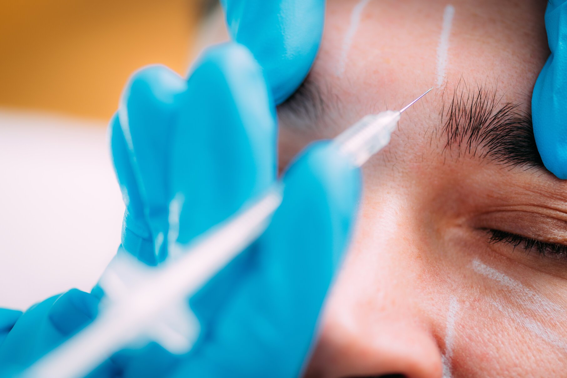 Dermal Fillers